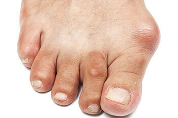 Bunions Treatment in the Scottsdale, AZ 85258 & Buckeye, AZ 85326 area