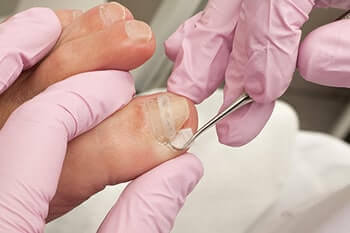 Ingrown toenail Treatment in the Scottsdale, AZ 85258 & Buckeye, AZ 85326 area 