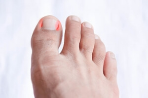 What Causes Ingrown Toenails?