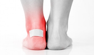 Why Do Blisters Develop?