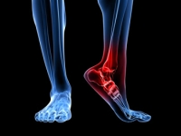 Ankle Sprains May Be Common Among Athletes
