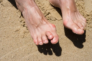 How Different Types of Arthritis Can Affect the Feet