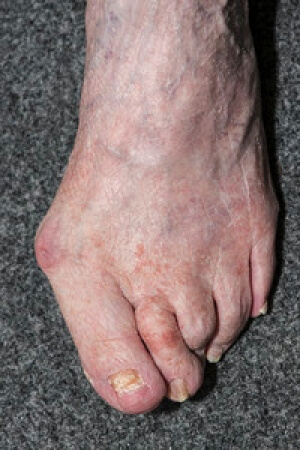 Possible Causes of Bunions
