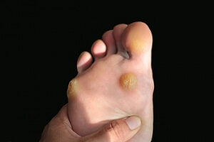 Possible Causes of Corns