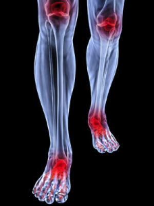 Rheumatoid Arthritis and the Feet