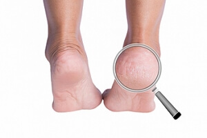 What Can Cause Cracked Heels?